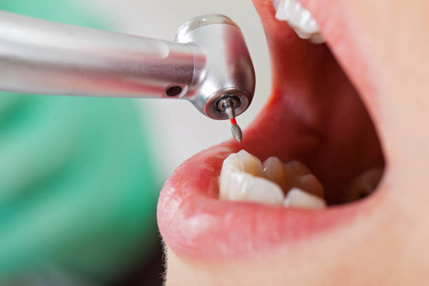 Best Chipped Tooth Repair Near Me  in Nashwauk, MN